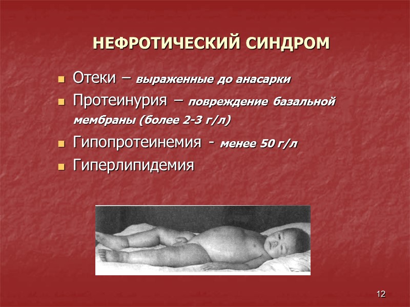 12 НЕФРОТИЧЕСКИЙ СИНДРОМ Отеки – выраженные до анасарки Протеинурия – повреждение базальной мембраны (более